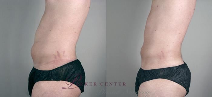 Liposuction Case 627 Before & After View #4 | Paramus, NJ | Parker Center for Plastic Surgery