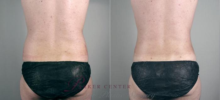 Liposuction Case 627 Before & After View #5 | Paramus, NJ | Parker Center for Plastic Surgery