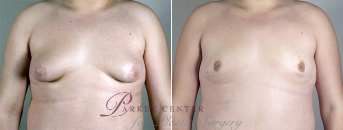 Gynecomastia Surgery Case 628 Before & After View #1 | Paramus, NJ | Parker Center for Plastic Surgery