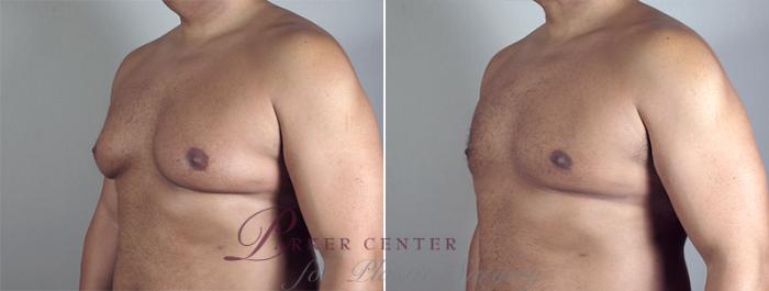 Gynecomastia Surgery Case 631 Before & After View #1 | Paramus, NJ | Parker Center for Plastic Surgery