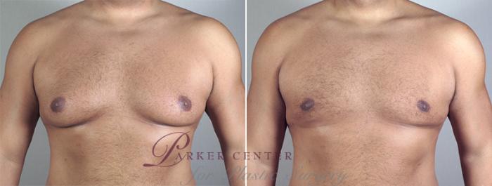 Gynecomastia Surgery Case 631 Before & After View #2 | Paramus, NJ | Parker Center for Plastic Surgery