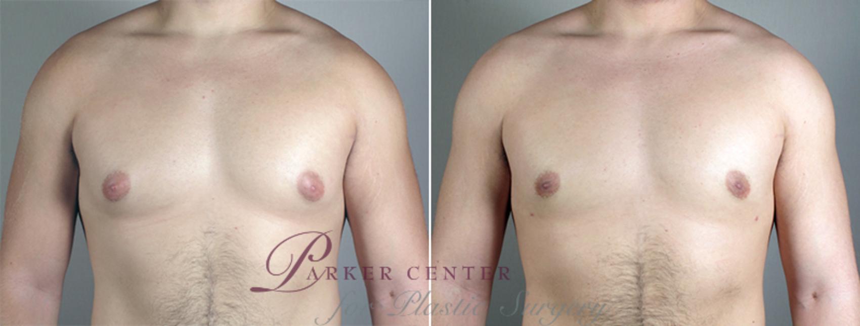 Gynecomastia Surgery Before and After Pictures Case 635 | Paramus, NJ | Parker Center for Plastic Surgery