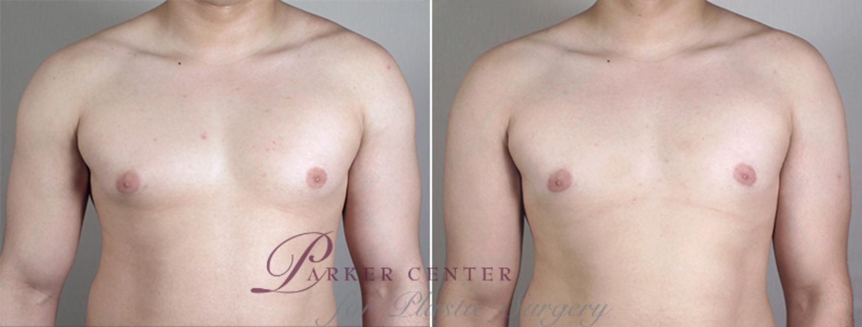 Gynecomastia Surgery Case 638 Before & After View #1 | Paramus, NJ | Parker Center for Plastic Surgery