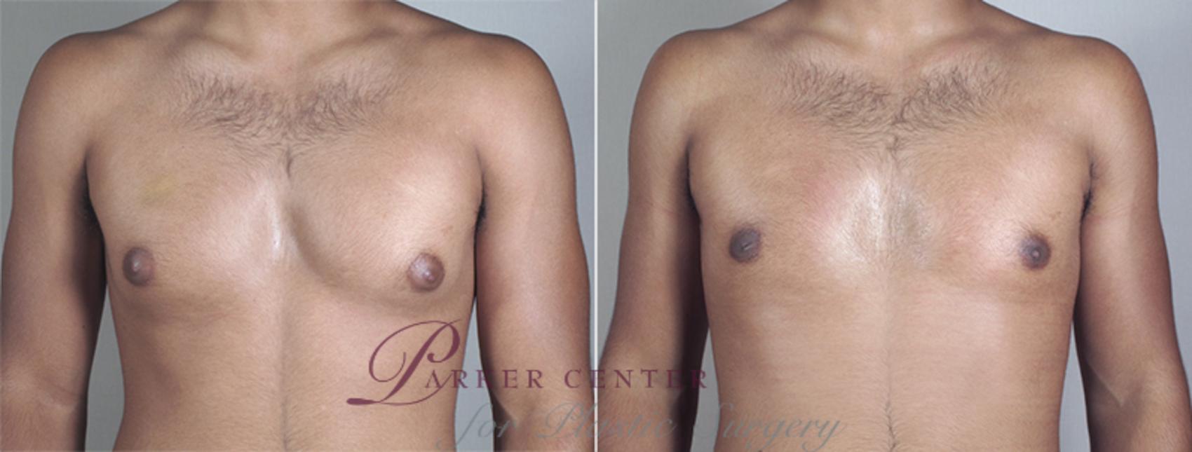 Gynecomastia Surgery Case 639 Before & After View #1 | Paramus, NJ | Parker Center for Plastic Surgery