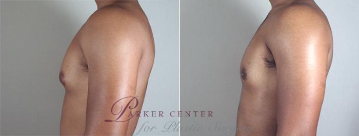 Gynecomastia Surgery Case 639 Before & After View #3 | Paramus, NJ | Parker Center for Plastic Surgery
