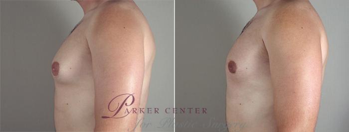 Gynecomastia Surgery Case 640 Before & After View #3 | Paramus, NJ | Parker Center for Plastic Surgery