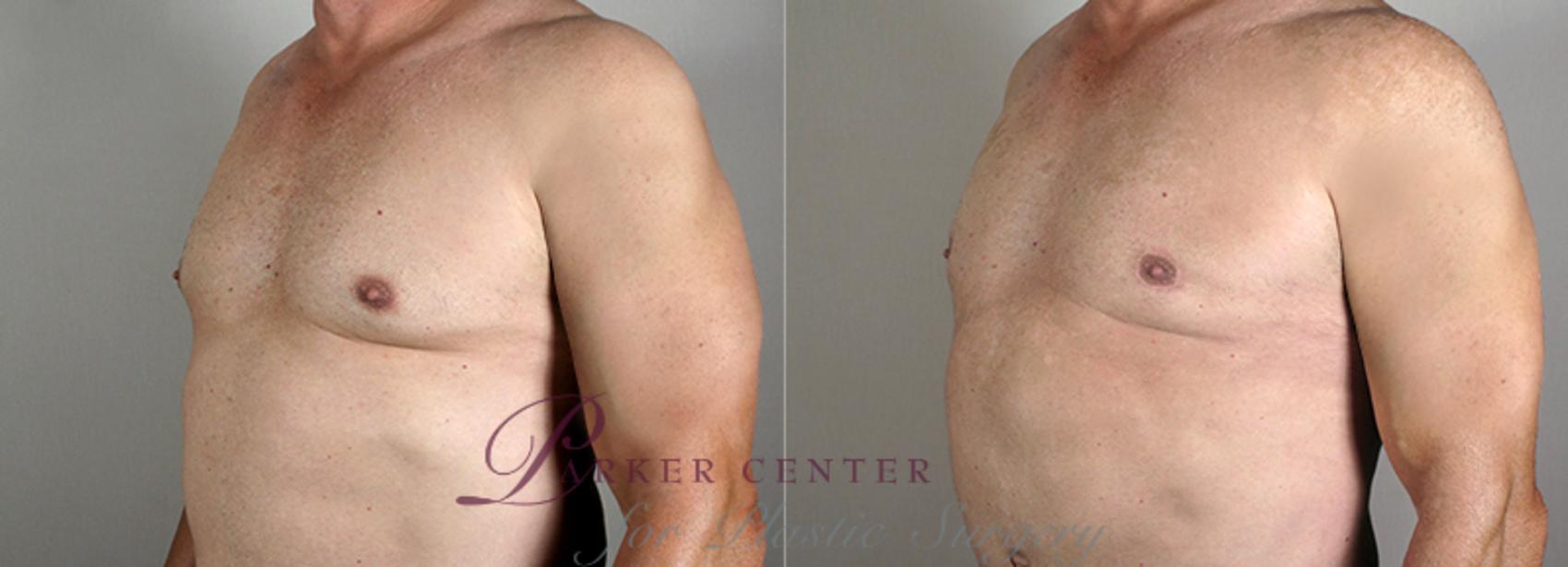 Abdominoplasty Case 641 Before & After View #5 | Paramus, NJ | Parker Center for Plastic Surgery
