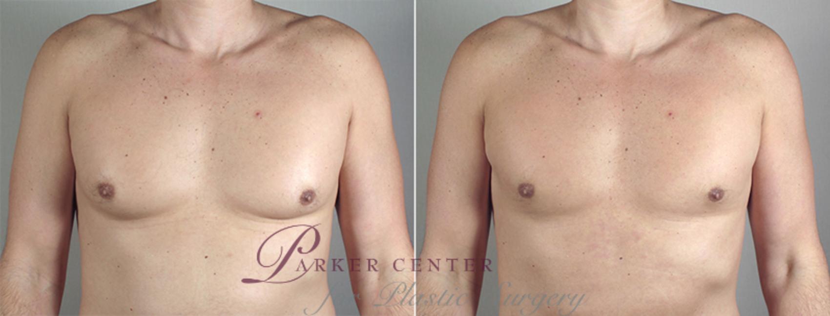 Gynecomastia Surgery Case 649 Before & After View #4 | Paramus, NJ | Parker Center for Plastic Surgery