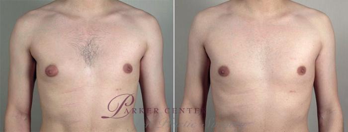 Nipple & Areola Surgery  Nipple Surgery Upper East Side