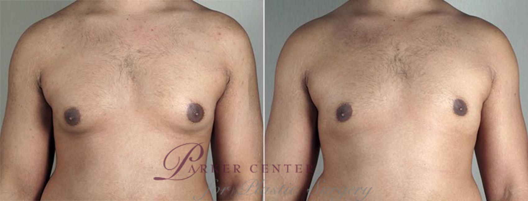 Gynecomastia Surgery Case 651 Before & After View #1 | Paramus, NJ | Parker Center for Plastic Surgery