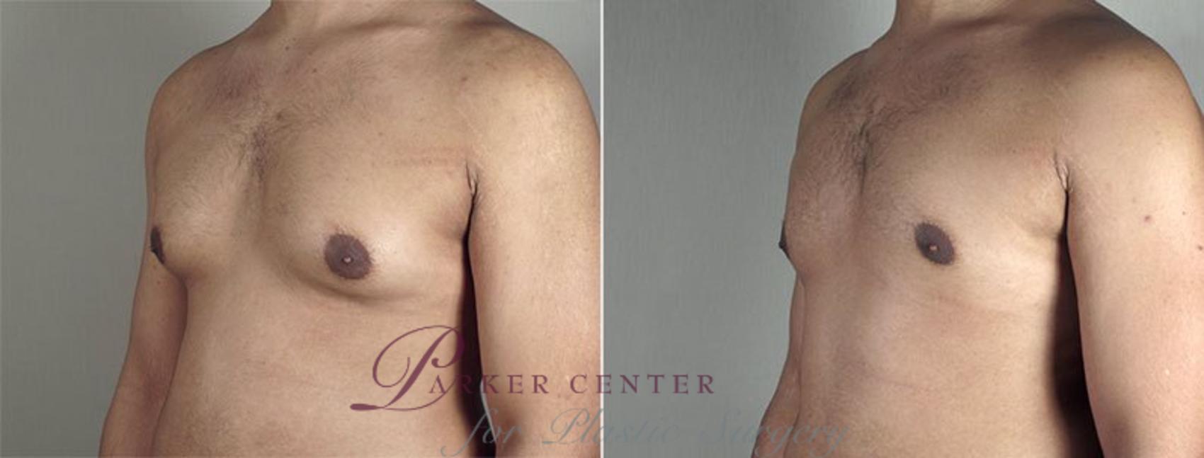 Gynecomastia Surgery Case 651 Before & After View #2 | Paramus, NJ | Parker Center for Plastic Surgery