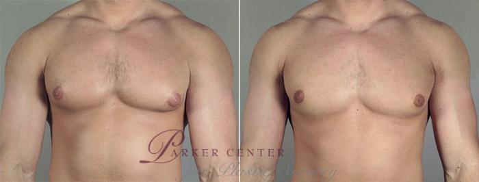 Gynecomastia Surgery Case 655 Before & After View #1 | Paramus, NJ | Parker Center for Plastic Surgery