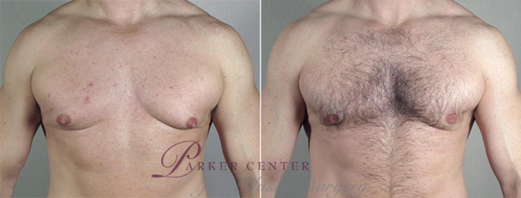 Gynecomastia Surgery Case 659 Before & After View #1 | Paramus, NJ | Parker Center for Plastic Surgery