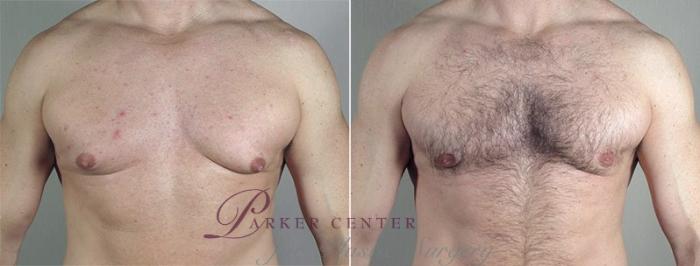 Gynecomastia Surgery Case 659 Before & After View #1 | Paramus, NJ | Parker Center for Plastic Surgery
