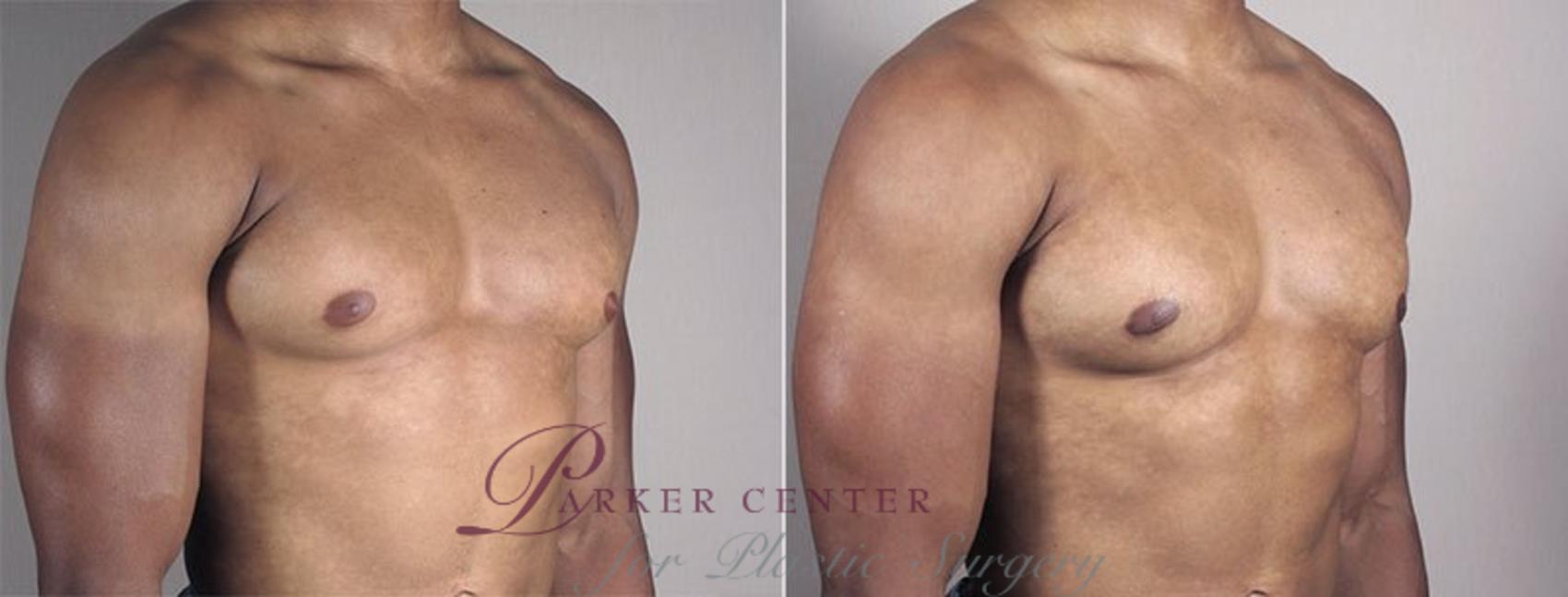 Gynecomastia Surgery Case 670 Before & After View #2 | Paramus, NJ | Parker Center for Plastic Surgery
