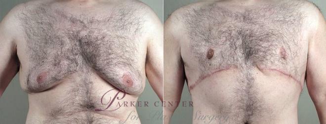 Tummy Tuck Case 673 Before & After View #5 | Paramus, NJ | Parker Center for Plastic Surgery