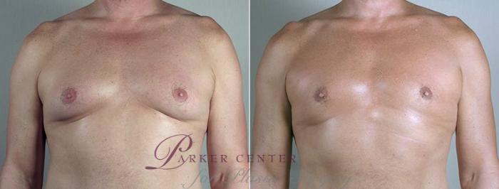 Gynecomastia Surgery Case 674 Before & After View #1 | Paramus, NJ | Parker Center for Plastic Surgery