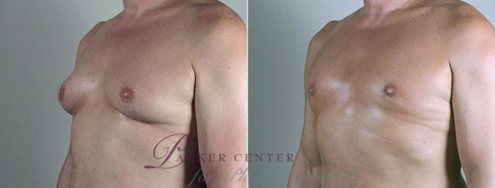 Gynecomastia Surgery Case 674 Before & After View #2 | Paramus, NJ | Parker Center for Plastic Surgery