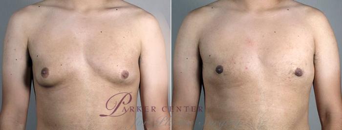 Gynecomastia Surgery Case 677 Before & After View #1 | Paramus, NJ | Parker Center for Plastic Surgery