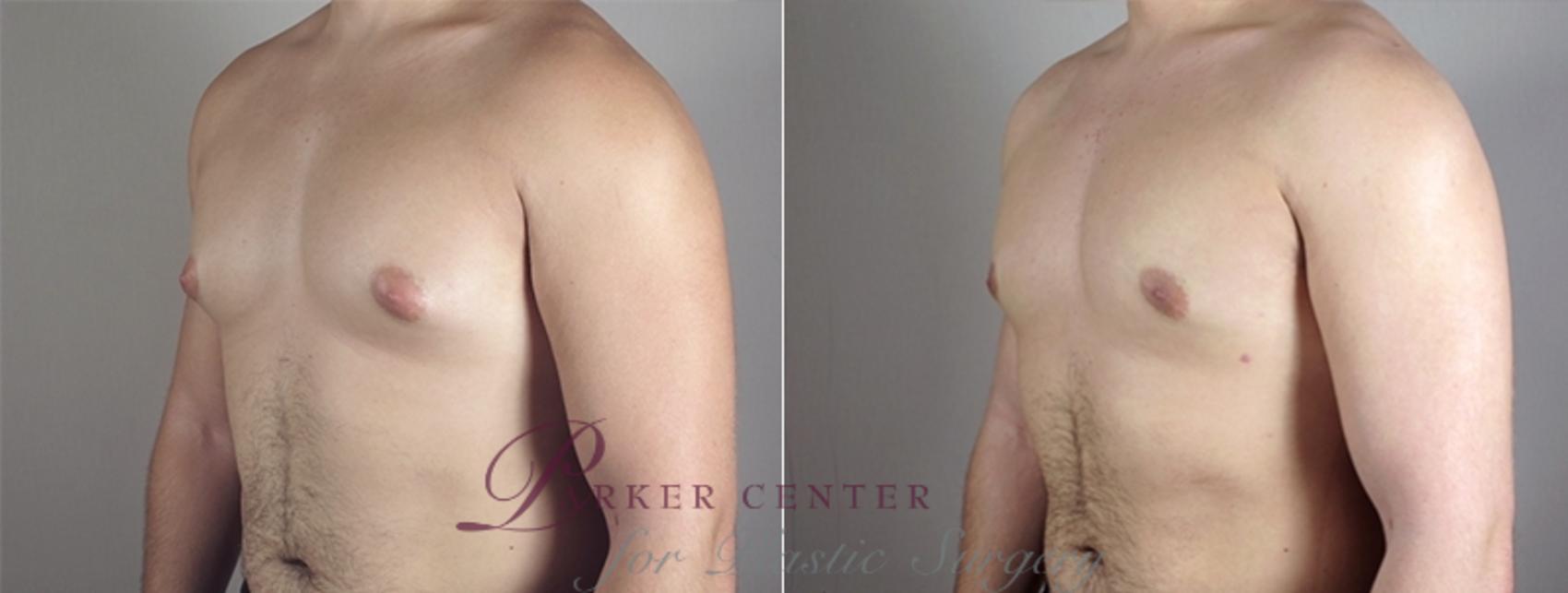 Gynecomastia Surgery Case 939 Before & After View #5 | Paramus, NJ | Parker Center for Plastic Surgery