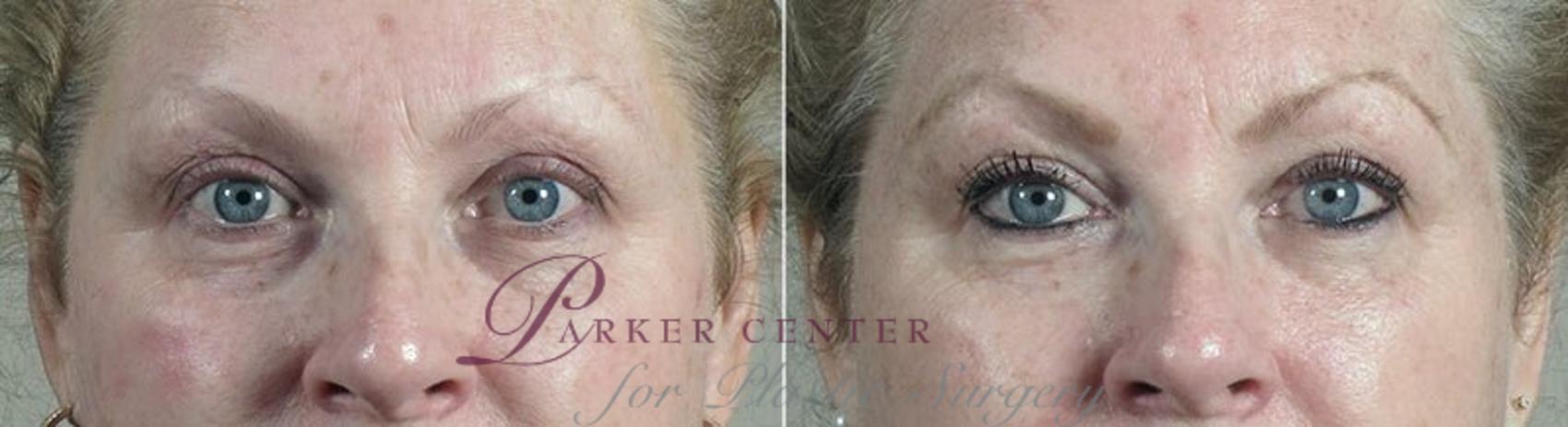 Halo™ Hybrid Fractional Case 303 Before & After View #1 | Paramus, New Jersey | Parker Center for Plastic Surgery