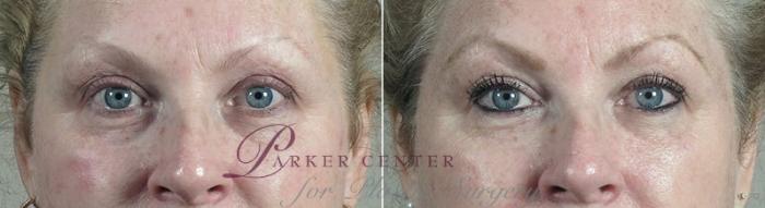 Halo™ Hybrid Fractional Case 303 Before & After View #1 | Paramus, New Jersey | Parker Center for Plastic Surgery