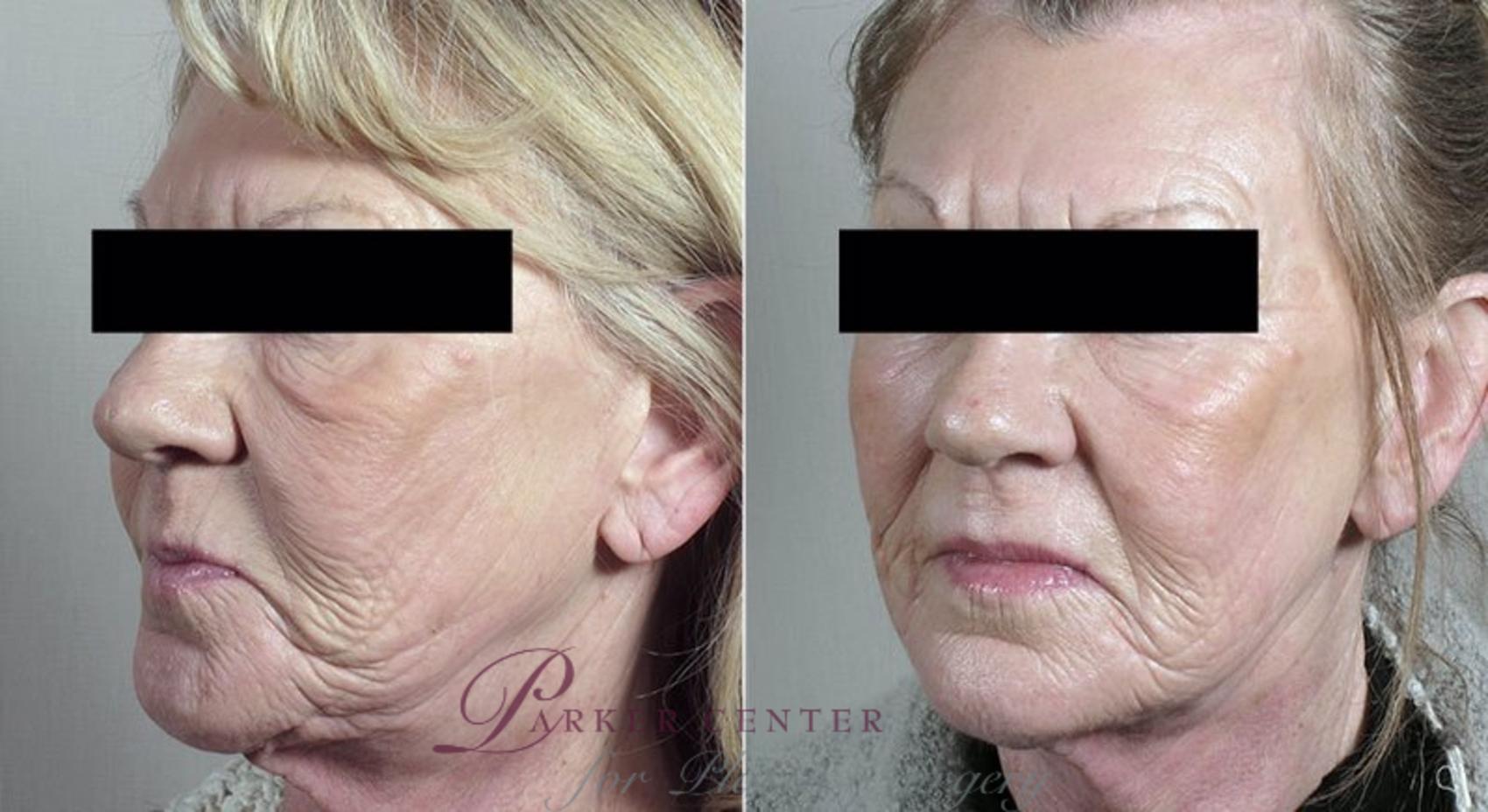 Halo™ Hybrid Fractional Case 304 Before & After View #1 | Paramus, New Jersey | Parker Center for Plastic Surgery
