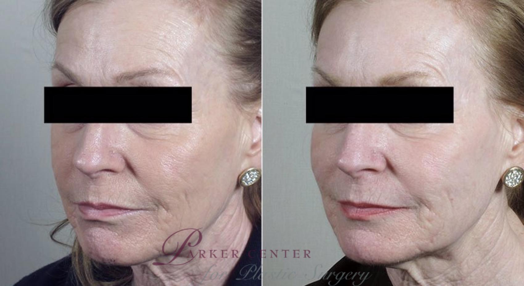 Halo™ Hybrid Fractional Case 305 Before & After View #1 | Paramus, New Jersey | Parker Center for Plastic Surgery