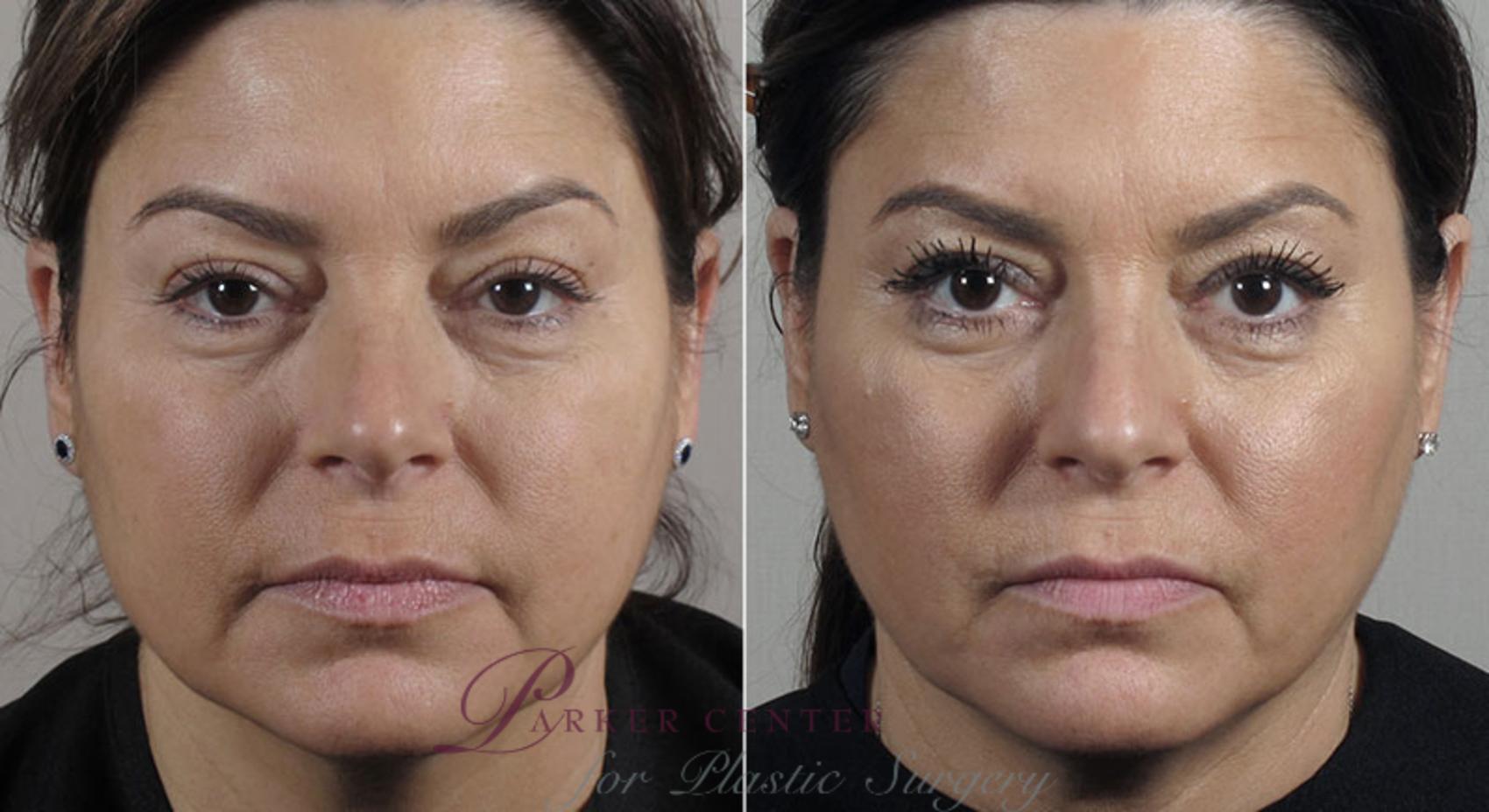 Nonsurgical Face Procedures Case 306 Before & After View #1 | Paramus, New Jersey | Parker Center for Plastic Surgery