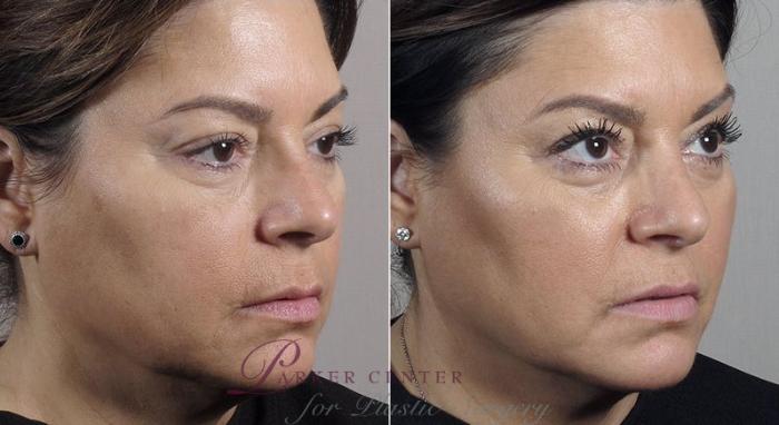 Nonsurgical Face Procedures Case 306 Before & After View #2 | Paramus, New Jersey | Parker Center for Plastic Surgery