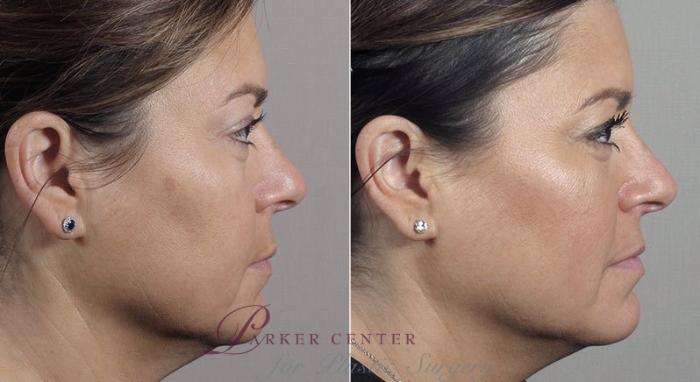 Nonsurgical Face Procedures Case 306 Before & After View #3 | Paramus, New Jersey | Parker Center for Plastic Surgery