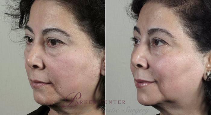 Halo™ Hybrid Fractional Case 308 Before & After View #2 | Paramus, New Jersey | Parker Center for Plastic Surgery