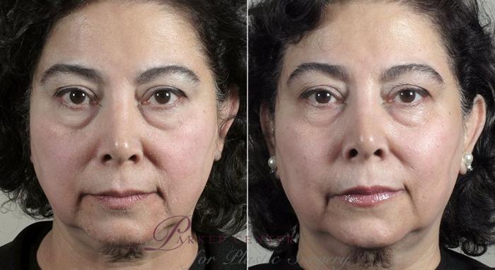 Halo™ Hybrid Fractional Case 308 Before & After View #3 | Paramus, New Jersey | Parker Center for Plastic Surgery