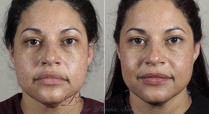 Halo™ Laser & Forever Young BBL™ Case 309 Before & After View #1 | Paramus, New Jersey | Parker Center for Plastic Surgery