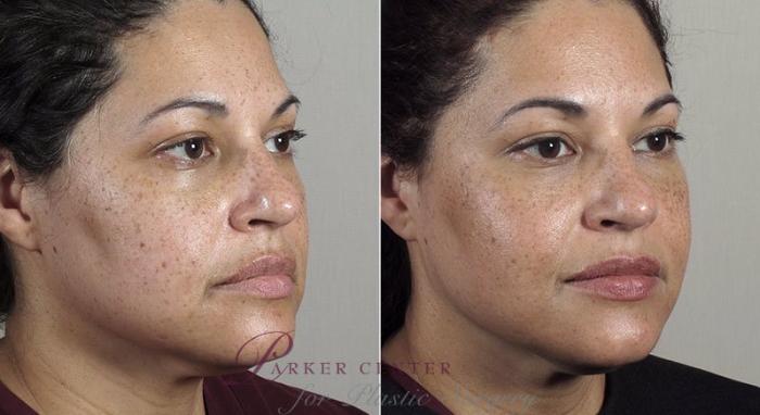 Nonsurgical Face Procedures Case 309 Before & After View #2 | Paramus, New Jersey | Parker Center for Plastic Surgery