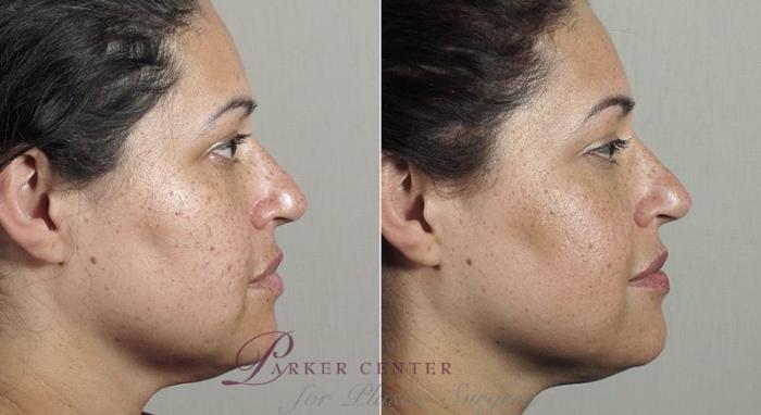 Nonsurgical Face Procedures Case 309 Before & After View #3 | Paramus, New Jersey | Parker Center for Plastic Surgery