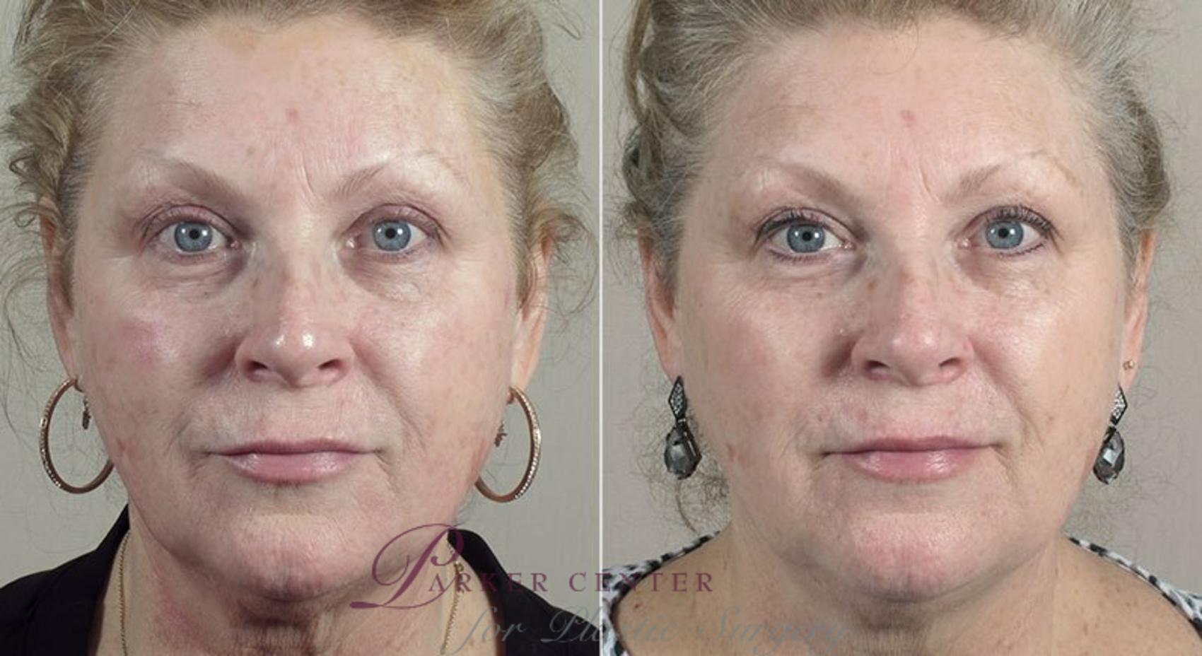 Nonsurgical Face Procedures Case 310 Before & After View #1 | Paramus, New Jersey | Parker Center for Plastic Surgery