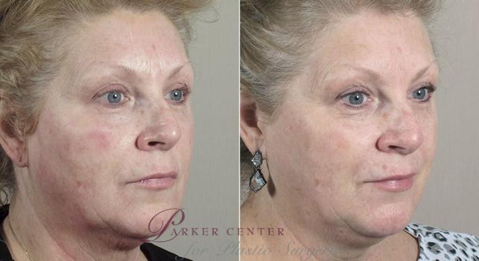 Nonsurgical Face Procedures Case 310 Before & After View #2 | Paramus, New Jersey | Parker Center for Plastic Surgery