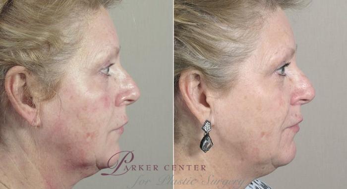 Nonsurgical Face Procedures Case 310 Before & After View #3 | Paramus, New Jersey | Parker Center for Plastic Surgery
