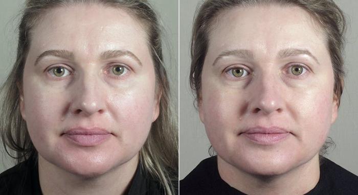 Halo™ Hybrid Fractional Case 311 Before & After View #2 | Paramus, New Jersey | Parker Center for Plastic Surgery