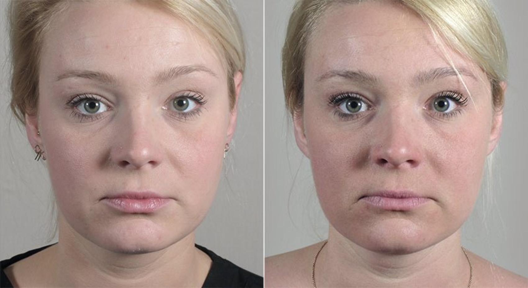 Halo™ Hybrid Fractional Case 312 Before & After View #1 | Paramus, New Jersey | Parker Center for Plastic Surgery