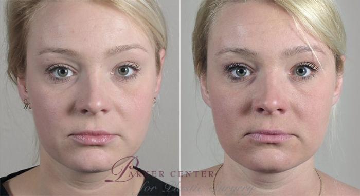 Halo™ Hybrid Fractional Case 312 Before & After View #1 | Paramus, New Jersey | Parker Center for Plastic Surgery