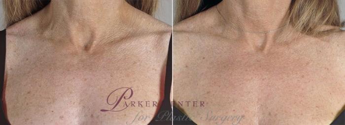 Halo™ Hybrid Fractional Case 313 Before & After View #1 | Paramus, New Jersey | Parker Center for Plastic Surgery