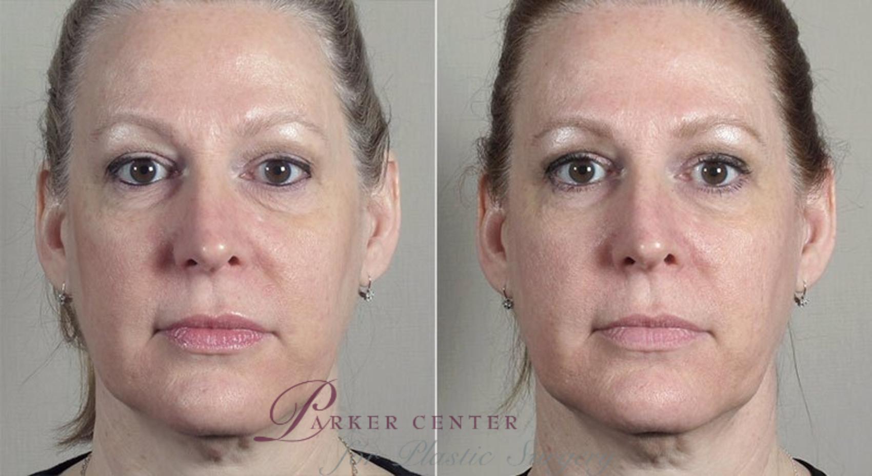 Halo™ Hybrid Fractional Case 315 Before & After View #1 | Paramus, New Jersey | Parker Center for Plastic Surgery