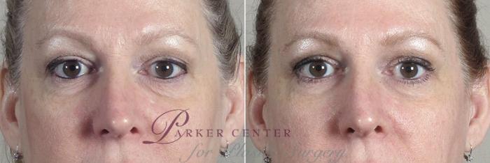 Halo™ Hybrid Fractional Case 315 Before & After View #2 | Paramus, New Jersey | Parker Center for Plastic Surgery