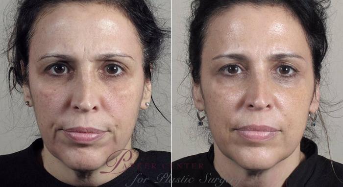 Halo™ Hybrid Fractional Case 316 Before & After View #1 | Paramus, New Jersey | Parker Center for Plastic Surgery