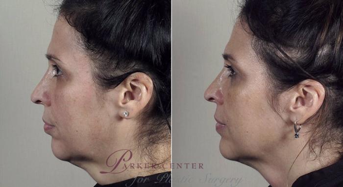 Halo™ Hybrid Fractional Case 316 Before & After View #3 | Paramus, New Jersey | Parker Center for Plastic Surgery