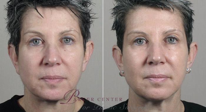Halo™ Hybrid Fractional Case 317 Before & After View #1 | Paramus, New Jersey | Parker Center for Plastic Surgery
