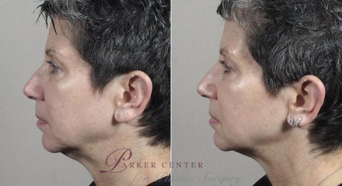 Halo™ Hybrid Fractional Case 317 Before & After View #2 | Paramus, New Jersey | Parker Center for Plastic Surgery