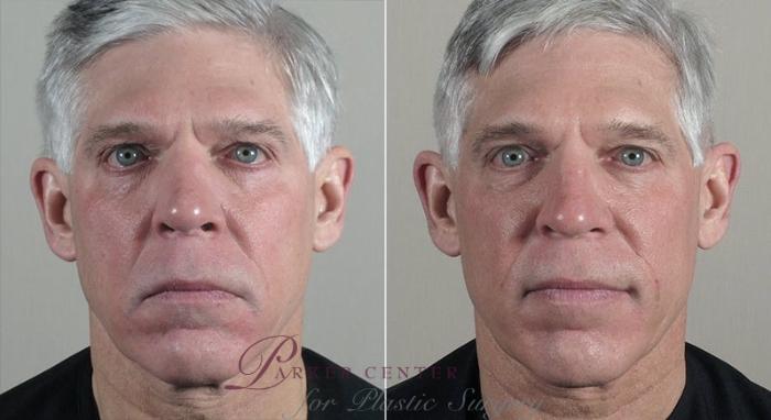 Halo™ Hybrid Fractional Case 318 Before & After View #1 | Paramus, New Jersey | Parker Center for Plastic Surgery